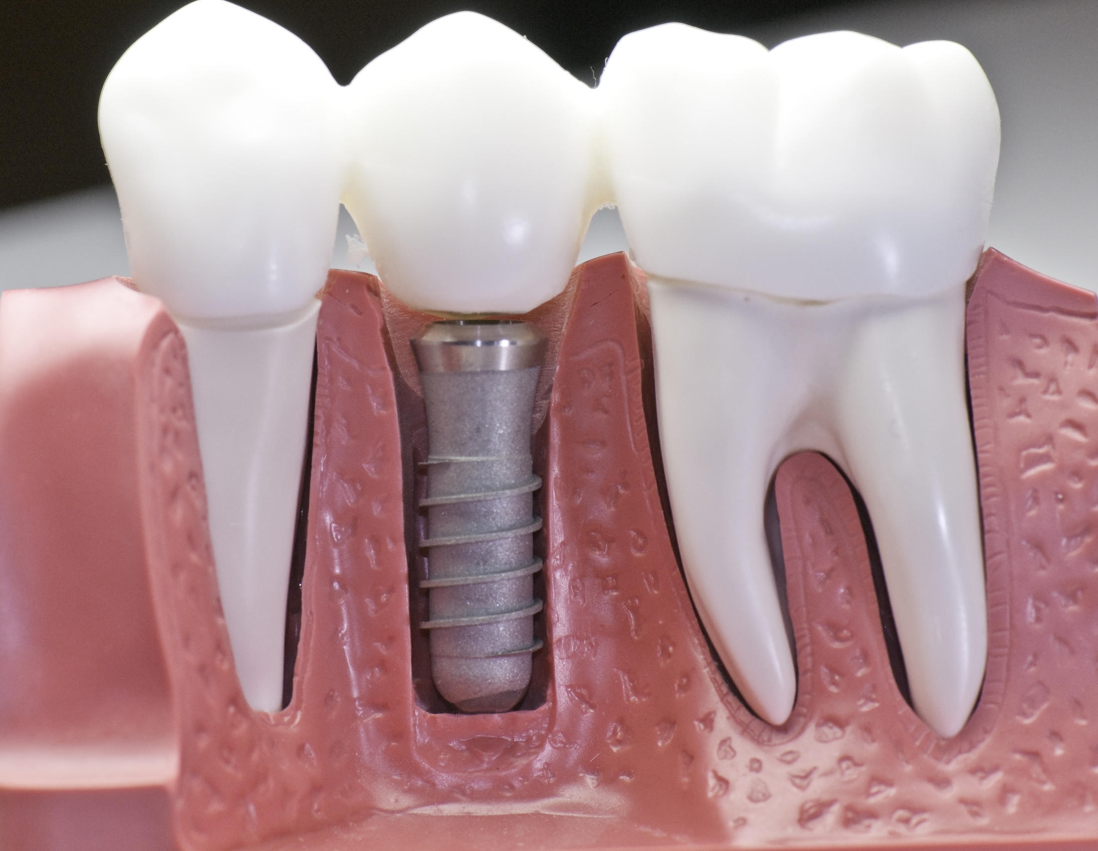 Tooth Implant Price | We are the experts of dental implant in Chatswood.