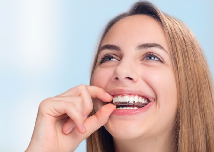 Invisalign cost in Parramatta