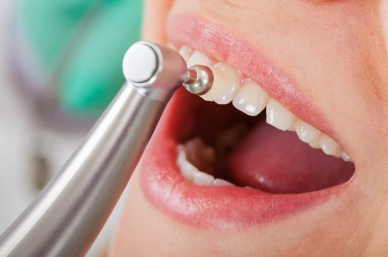 Teeth Cleaning Cost Parramatta Dentistry