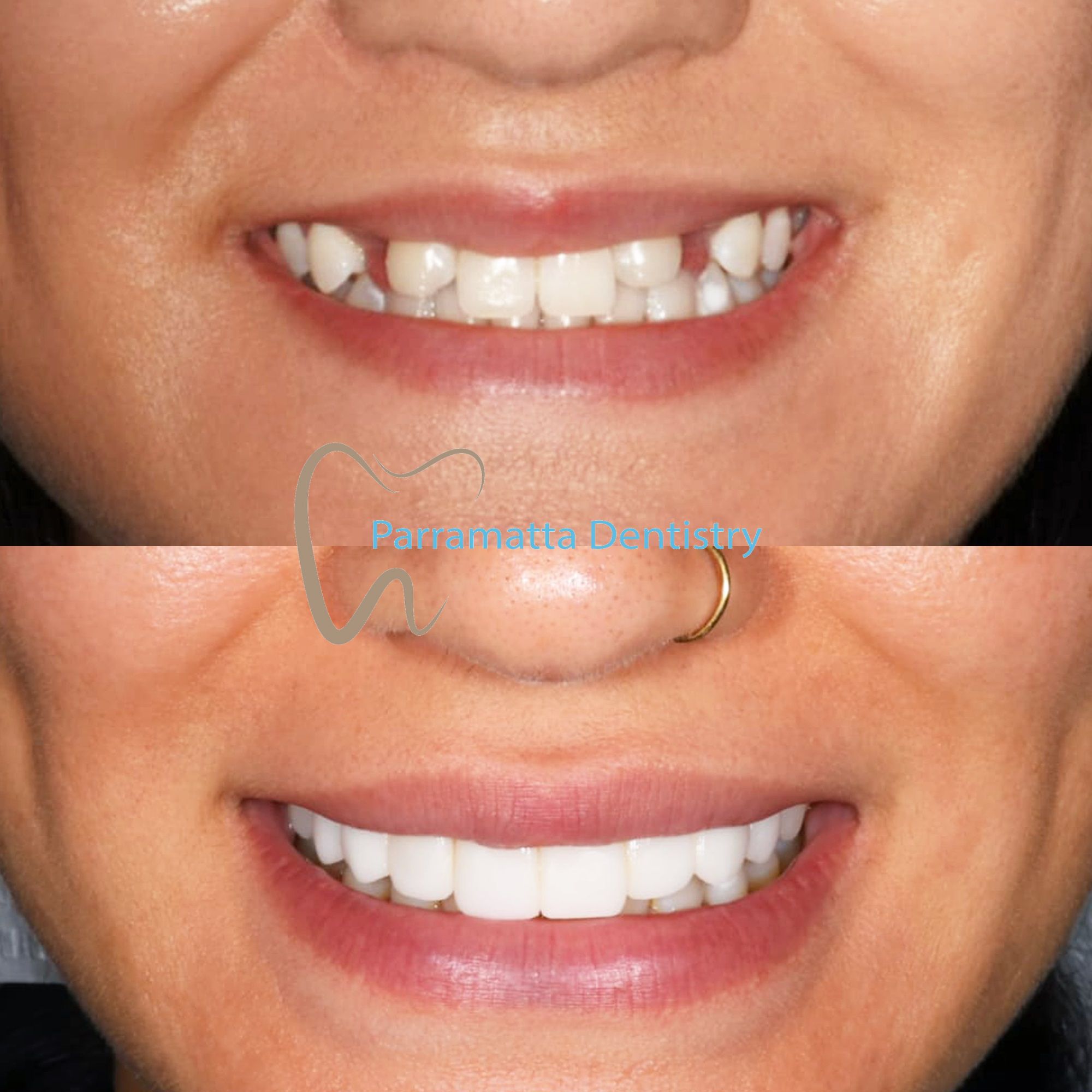 Dental Veneers Before and After