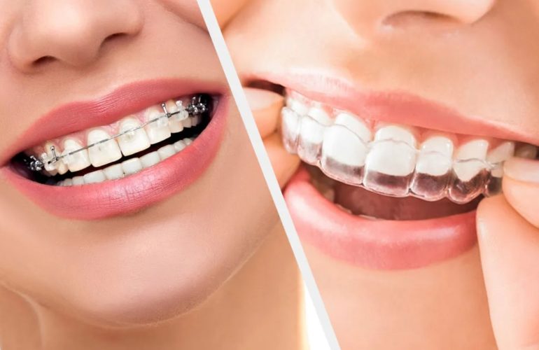 Invisalign vs Braces