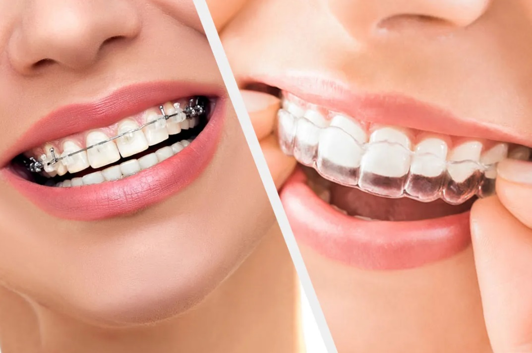 Invisalign vs Braces